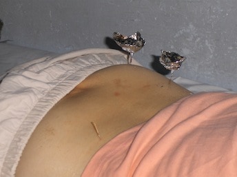 Moxibustion Moxibustion