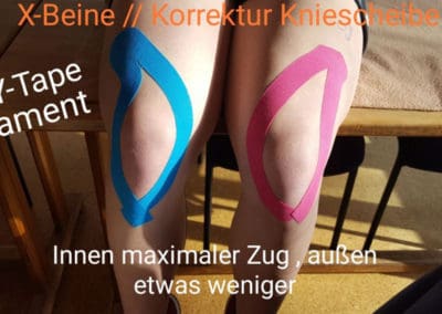 Kinesio-Taping Oberschenkel bei X-Beinen - Naturheilpraxis Maike Hoyer